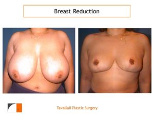 Vertical scar for breast reduction surgery