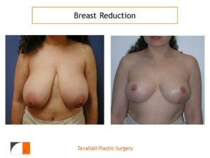 Breast reduction mammoplasty vertical scar s faded