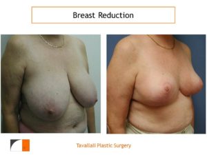 Breast reduction vertical technique before after