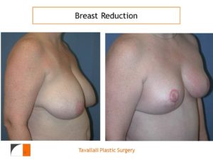Breast reduction scar of vertical method