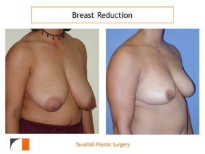 Breast reduction mammoplasty before and after