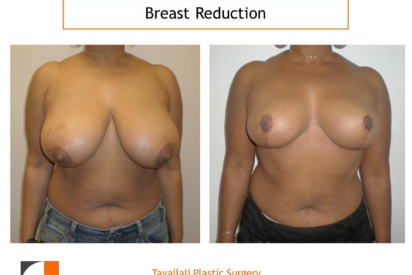 Breast reduction mammoplasty surgery before after