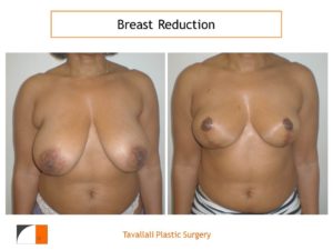 Breast reduction result with vertical mammoplasty