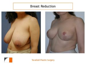 Breast reduction with short vertical scar before after photo Plastic Surgery No VA