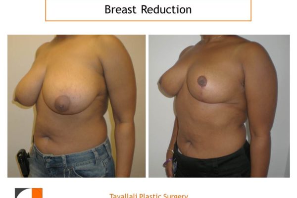 Breast reduction mammoplasty surgery before after