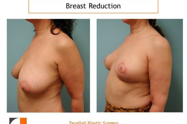 Breast reduction surgery early result