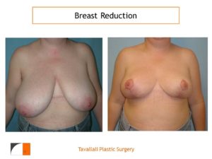 Breast reduction mammoplasty before and after