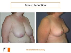 Breast reduction surgery before after