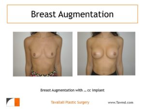 Breast augmentation with saline implants about 325 cc