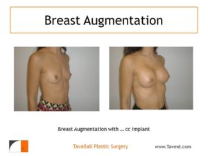 Breast augmentation with saline implants 325 cc