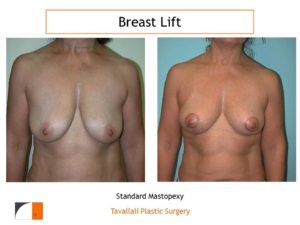 Breast lift with short scar Dr. Tavallali