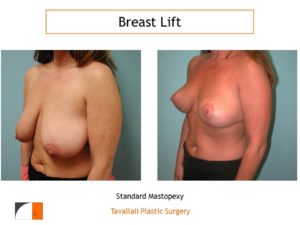 Breast lift short scar before after