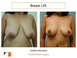 Breast lift before after and areola reduction