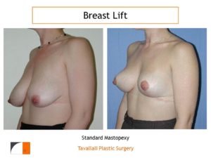 Breast lift mastopexy before after