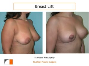Breast lift mastopexy before & after result