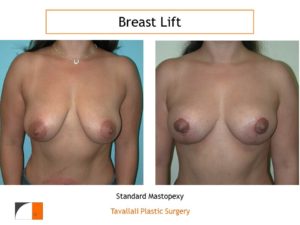 Breast lift mastopexy No VA surgery