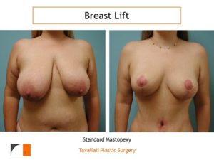 Breast lift surgery and breast reduction