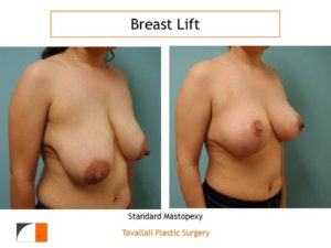 Breast lift surgery mastopexy before after