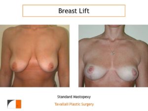 Breast lift early result with short scar