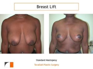 Breast lift vertical scar method before after