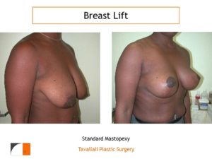 Breast lift vertical scar method before after