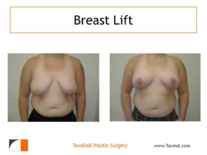 Breast lift surgery with vertical scar only