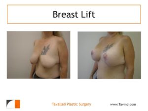Oblique view breast lift surgery small scar