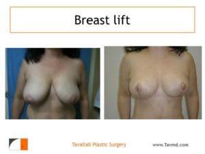 Breast lift surgery before after short vertical scar