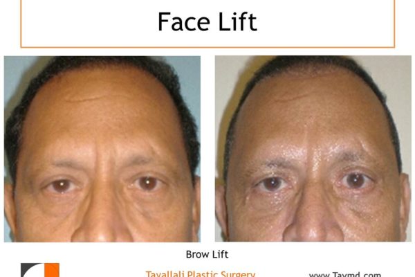 male with Brow lift Forehead lift before after