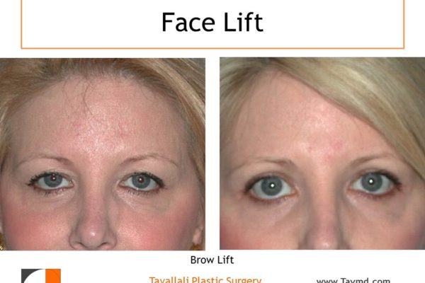 Eyelid lift and Brow lift Forehead lift before after