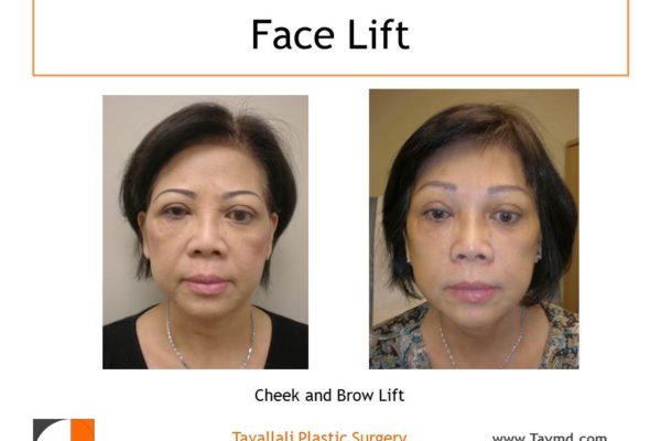 Brow lift Forehead lift and facelift before after