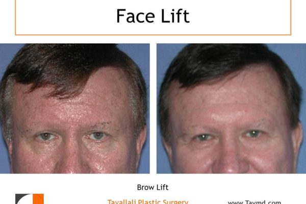 man with Brow lift Forehead elevation before after
