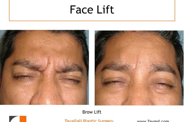 Glabella muscle removal Brow lift Forehead elevation before after
