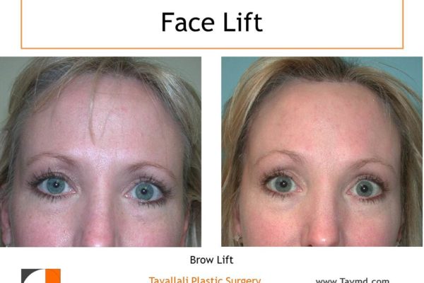 Brow lift Forehead elevation before after