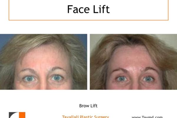 Brow lift Forehead lift before after