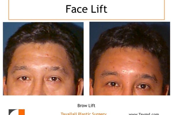 man with brow lift