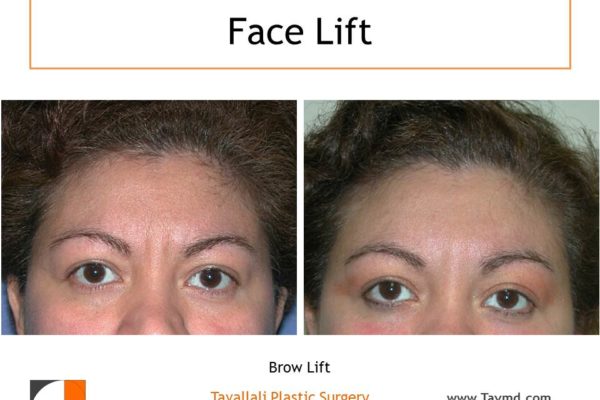 Brow lift Forehead surgery elevation before after
