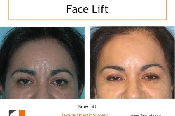 Woman with forehead lift surgery before & after