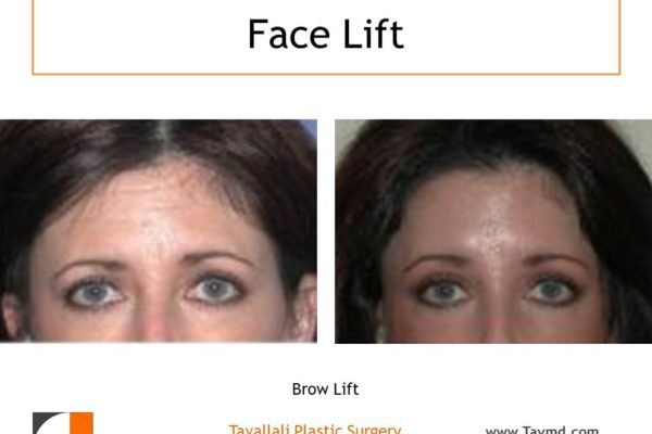 Brow lift removal forehead lines before after