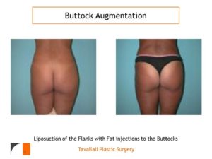 BBL Brazilian buttock lift augmentation of buttocks