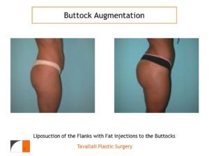 BBL Brazilian buttock lift augmentation before after