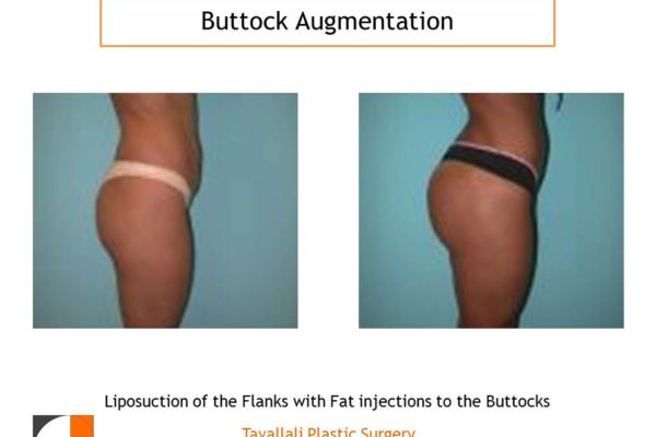 BBL Brazilian buttock lift augmentation before after