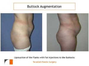 BBL Brazilian buttock lift augmentation results
