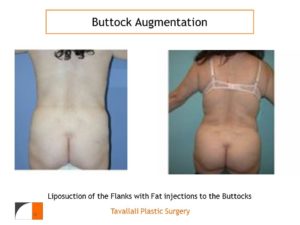 BBL Brazilian buttock lift enlargement of buttocks