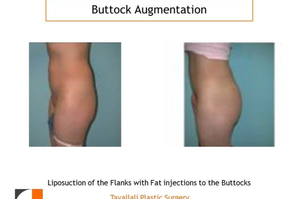 BBL Brazilian buttock lift enlargement profile