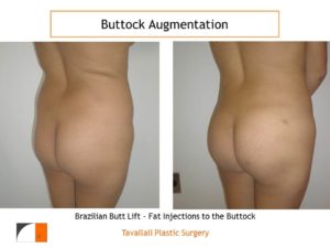 BBL Brazilian buttock lift fat injection to buttocks before and after