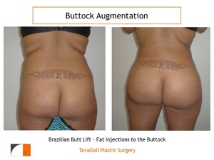 BBL Brazilian buttock lift fat injection for buttock enlargement
