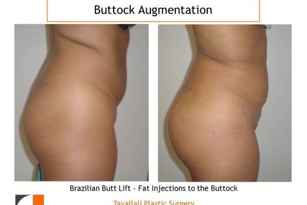 BBL Brazilian buttock lift