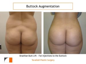 BBL Brazilian buttock lift fat injected to enlarge buttock