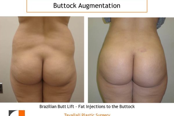 BBL Brazilian buttock lift fat injected to enlarge buttock